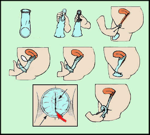 女性避孕套使用方法图解