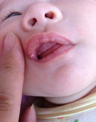 婴儿鹅口疮反复发作怎么办?