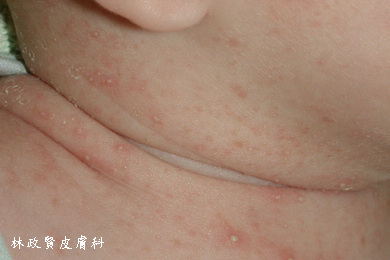 痱子的症状:痱子症状图片及治疗方法