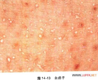 痱子的症状:痱子症状图片及治疗方法