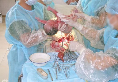 和妈妈一起分享 我亲身体验的剖腹产全过程（图）