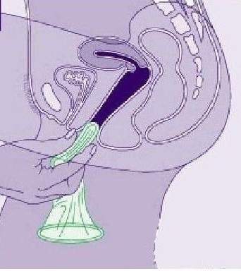 女用避孕套使用方法（演示） 帮你安全渡过&ldquo;造人计划&rdquo;