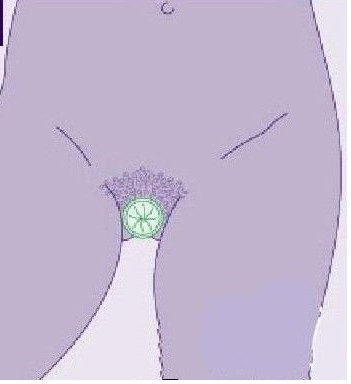 女用避孕套使用方法（演示） 帮你安全渡过&ldquo;造人计划&rdquo;