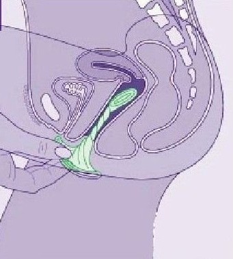 女用避孕套使用方法（演示） 帮你安全渡过&ldquo;造人计划&rdquo;