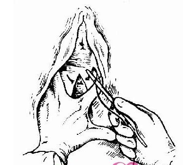 女人顺产侧切全过程(图片)