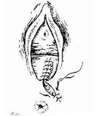 女人顺产侧切全过程(图片)