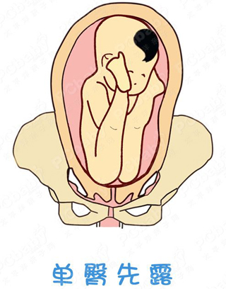 胎位不正怎么办?纠正胎位的正方法(图)