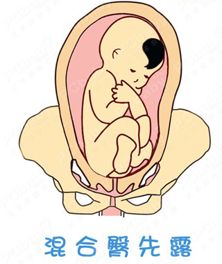胎位不正怎么办?纠正胎位的正方法(图)