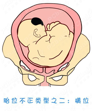胎位不正怎么办?纠正胎位的正方法(图)