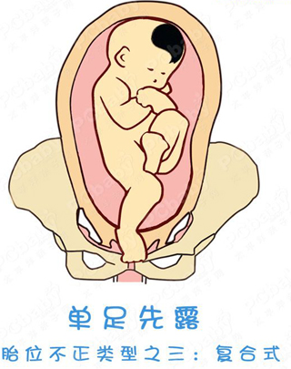 胎位不正怎么办?纠正胎位的正方法(图)