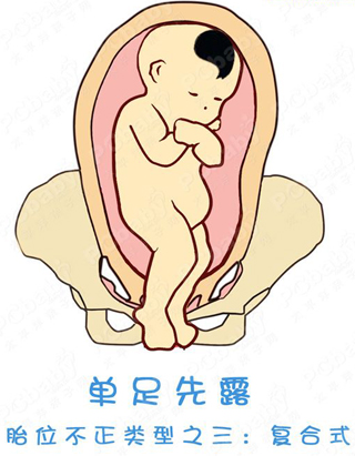 胎位不正怎么办?纠正胎位的正方法(图)