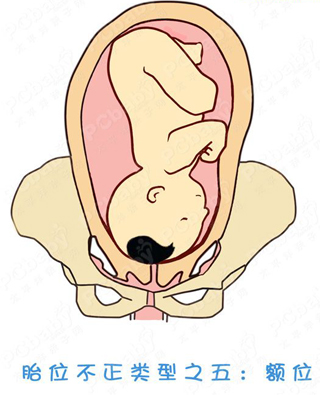 胎位不正怎么办?纠正胎位的正方法(图)