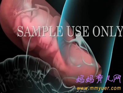 直击顺产会阴侧切手术全过程(图)