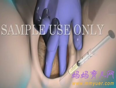 直击顺产会阴侧切手术全过程(图)