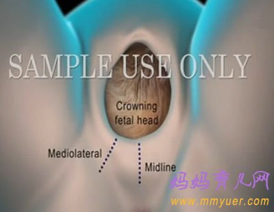 直击顺产会阴侧切手术全过程(图)