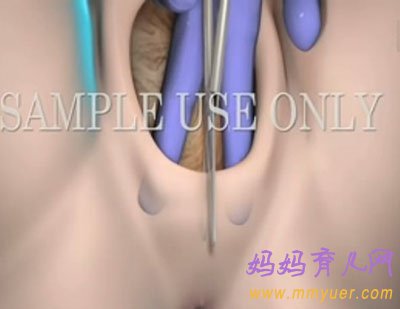 直击顺产会阴侧切手术全过程(图)