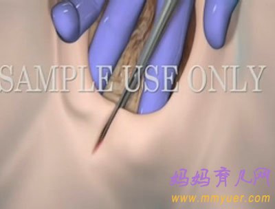 直击顺产会阴侧切手术全过程(图)