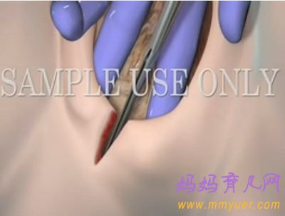 直击顺产会阴侧切手术全过程(图)