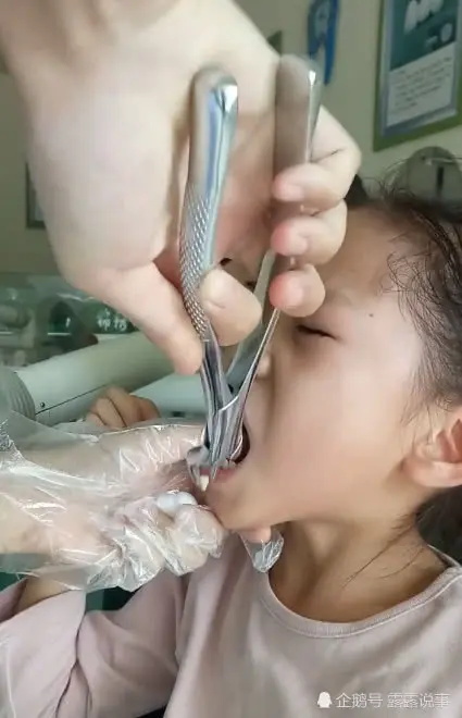 拔牙需要注意什么?拔牙十大禁忌症最好提前了解下