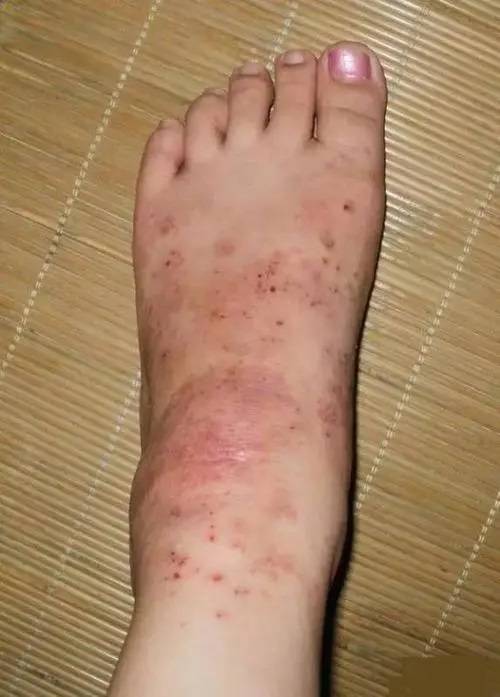 腿部脚部湿疹