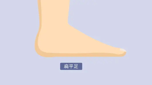 扁平足的7大矫正方法