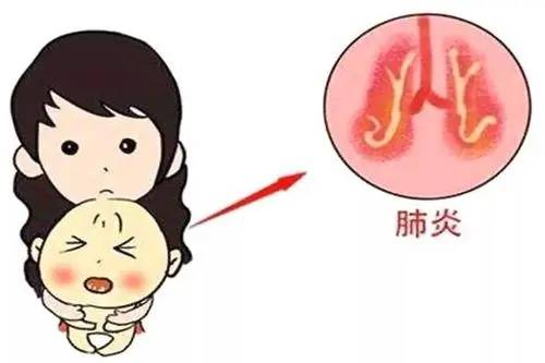 小儿肺炎有5个常见症状