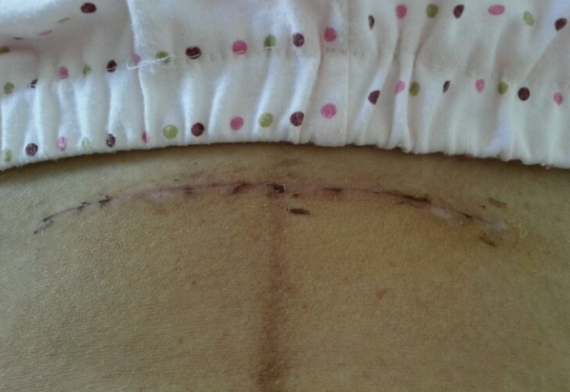 剖腹产刀口42天恢复情况