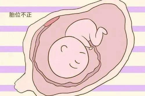 胎位不正是什么原因导致的 胎位不正要注意什么?