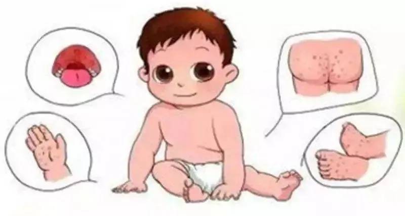 发现手足口疾病第一时间应该怎么做?