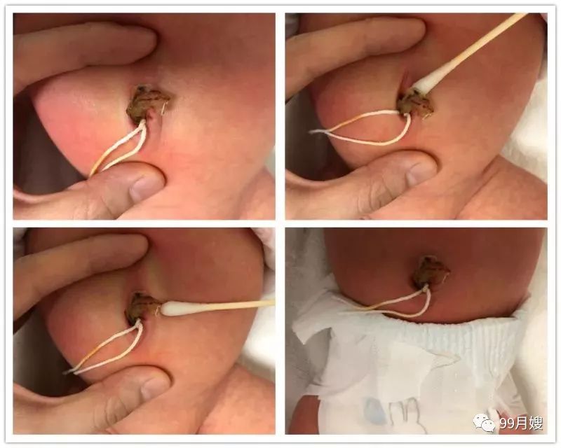 新生儿脐带护理碘伏_新生儿脐带护理用碘伏_新生儿脐带脱落后用碘伏消毒多久