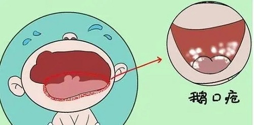 如何判断孩子是不是得了鹅口疮？如何治疗？