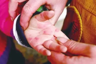 手足口刚开始是红点吗,手足口病一般几天能好?