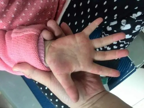 手足口刚开始是红点吗,手足口病一般几天能好?