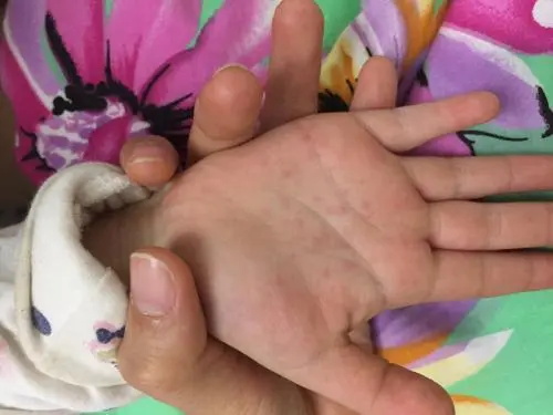 手足口刚开始是红点吗,手足口病一般几天能好?